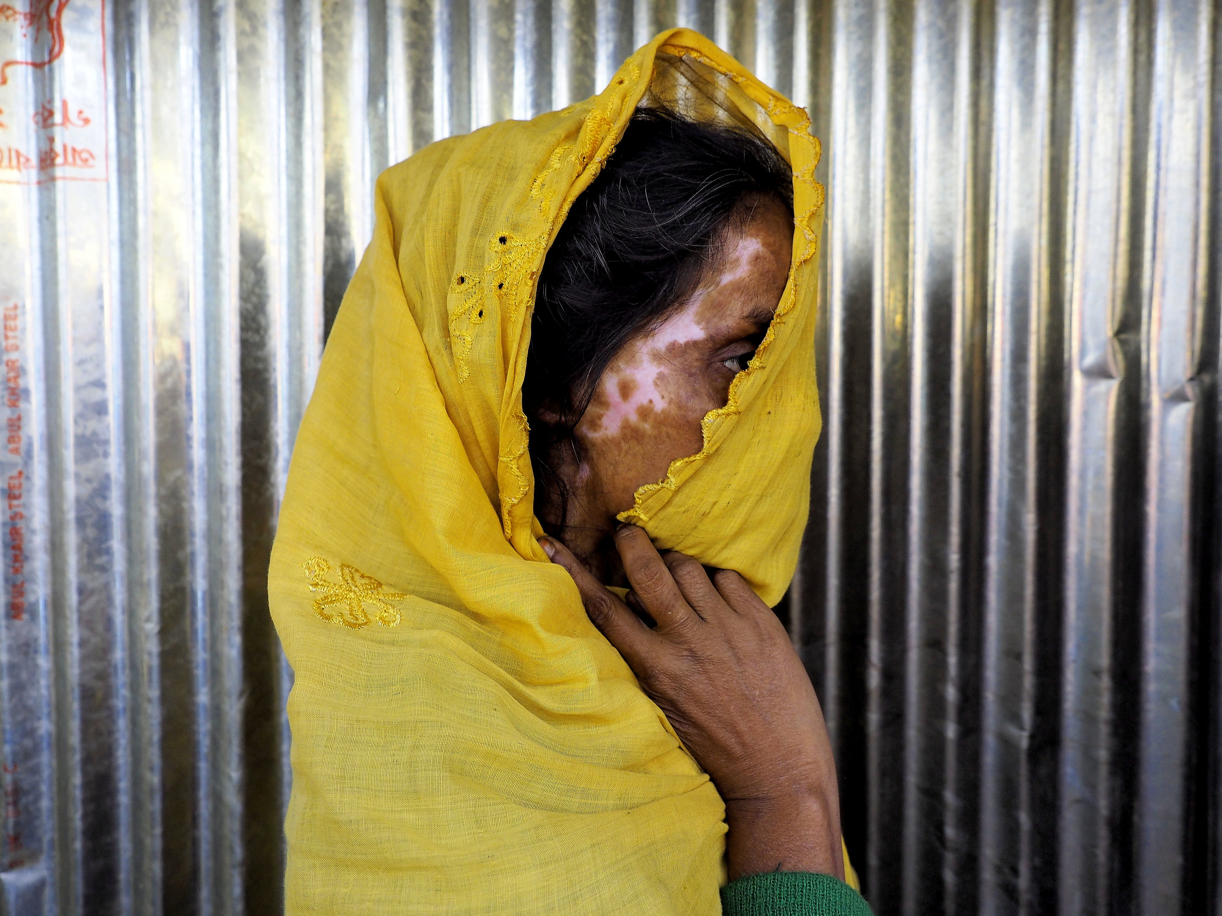 Rohingya refugee displays her burn scars. Image by Doug Bock Clark. Bangladesh, 2017. Rohingya refugee displays her burn scars. Image by Doug Bock Clark. Bangladesh, 2017.