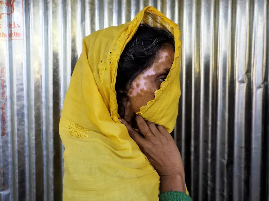A Rohingya refugee displays her scars. Image by Doug Bock Clark. Myanmar, 2017.