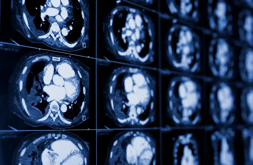 Computed tomography of the chest. Medical background. Monochrome photos. Image by sfam_photo/Shutterstock.