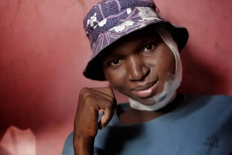 A month after his 18th birthday in September, Djooly Jeune had his final chemotherapy for Burkitt’s lymphoma at the University Hospital of Mirebalais, in central Haiti. In November, his facial tumor started to grow again. Image by José A. Iglesias. Haiti, 2018. 