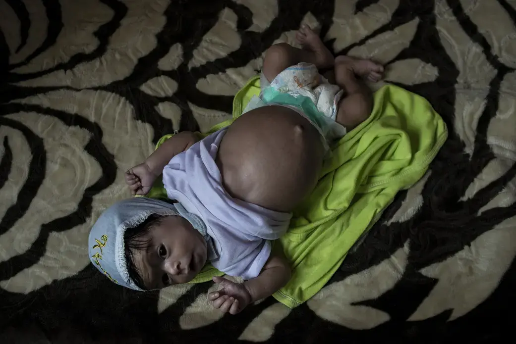 Nine-month-old Bushra lies on a bed, belly bloated from electrolyte imbalance and malnutrition. Image by Alex Potter. Yemen, 2018. 