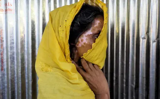 A Rohingya refugee displays her scars. Image by Doug Bock Clark. Myanmar, 2017.