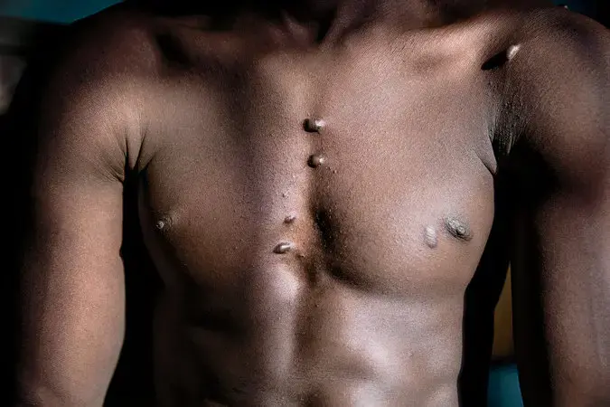 Ali was kept alive by Boko Haram for his farming skills but severely beaten and burned when he refused to go to a training camp. After he escaped, he was held in the Army’s infamous Giwa Barracks for months. Image by Glenna Gordon. Nigeria, 2017. 