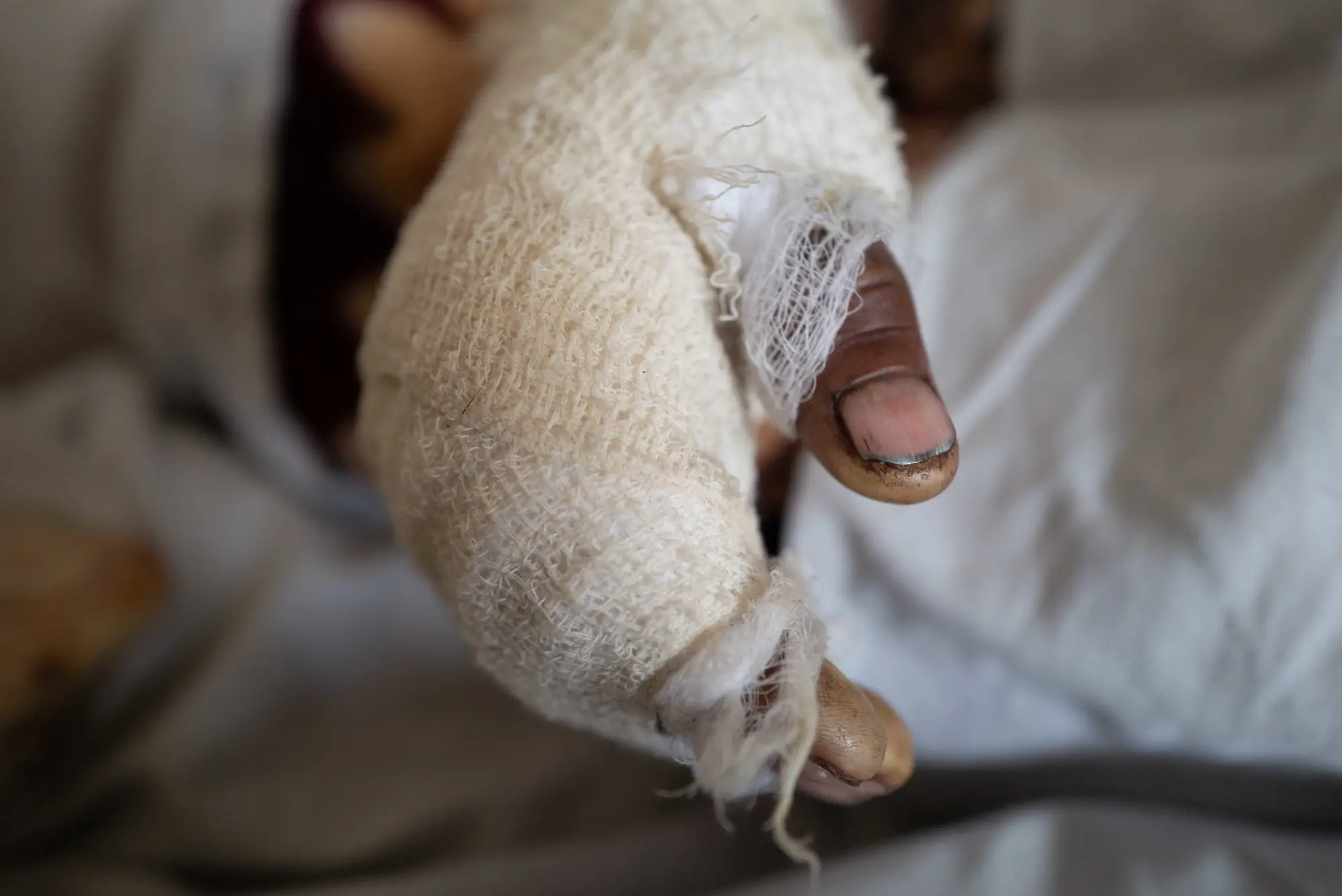A bandaged hand